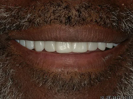 Patient smile, after