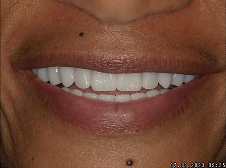 Patient smile, after