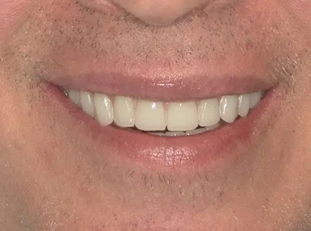 Patient smile, after