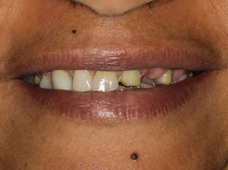 Patient smile, before