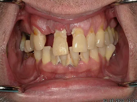 Patient smile, before