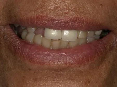 Patient smile, before