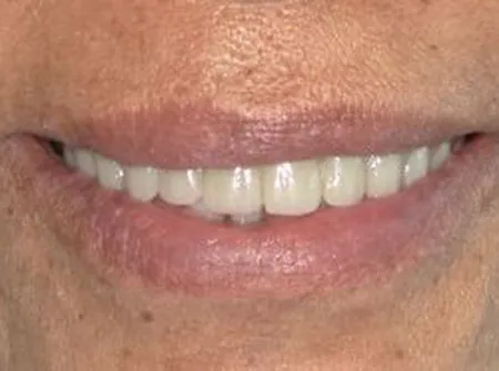 Patient smile, after