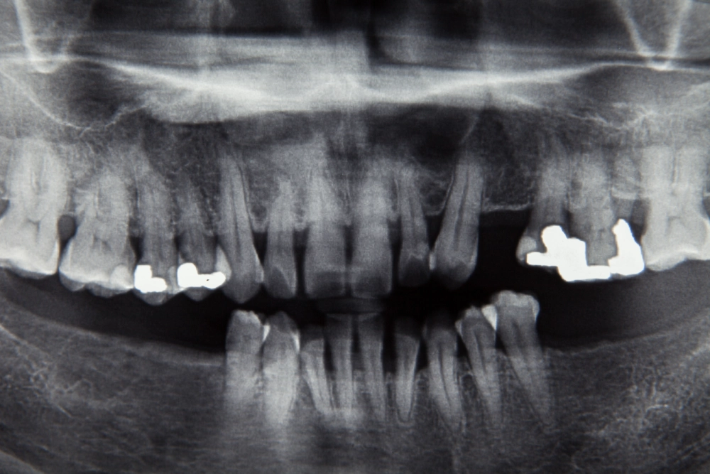 Loose or missing teeth on a dental X-ray