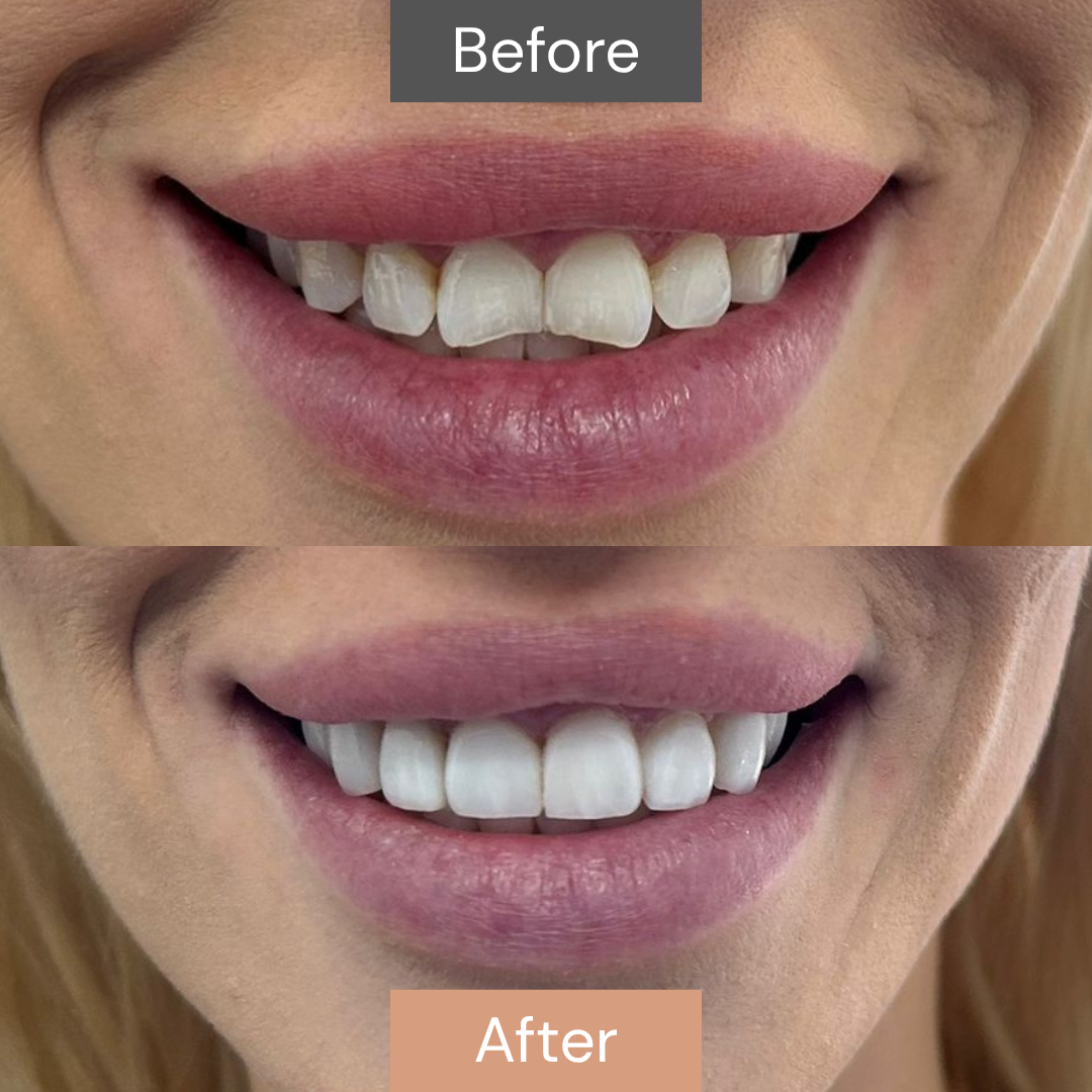 Composite bonding before and after — Hayley M.