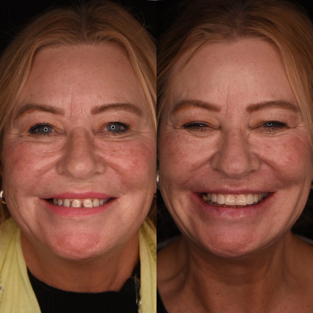 Composite bonding before and after