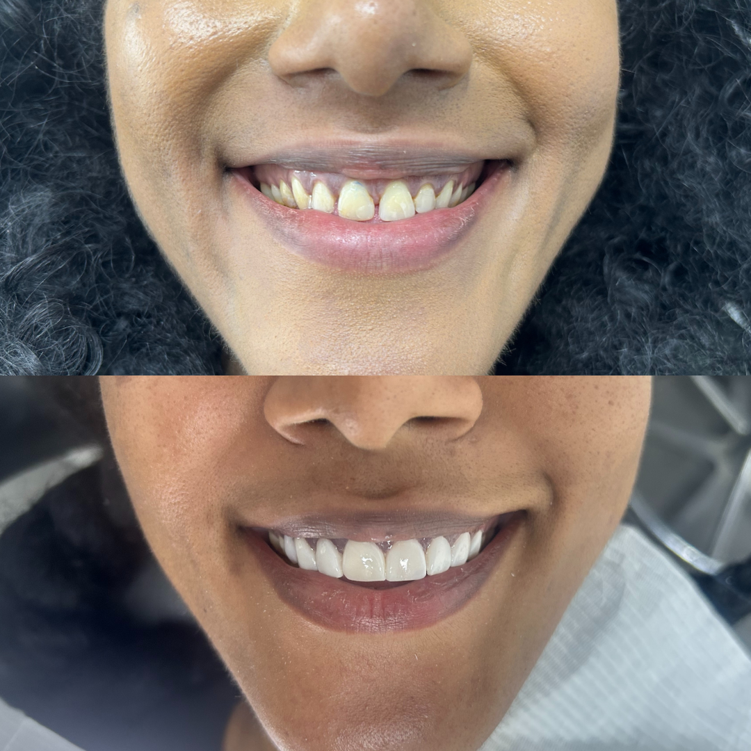 Composite bonding before and after — Nadia R.