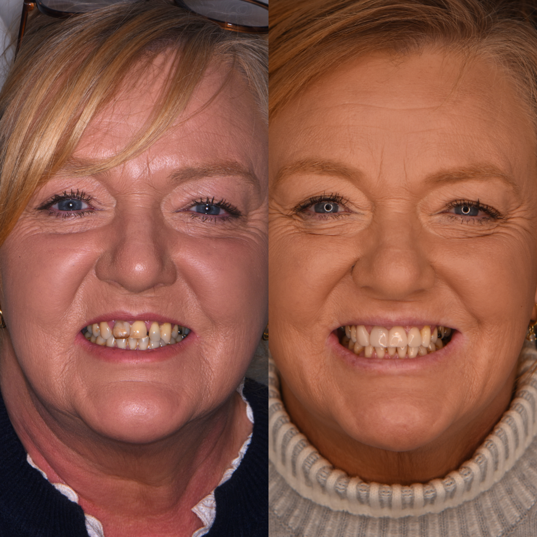 Composite bonding before and after — Michelle D.