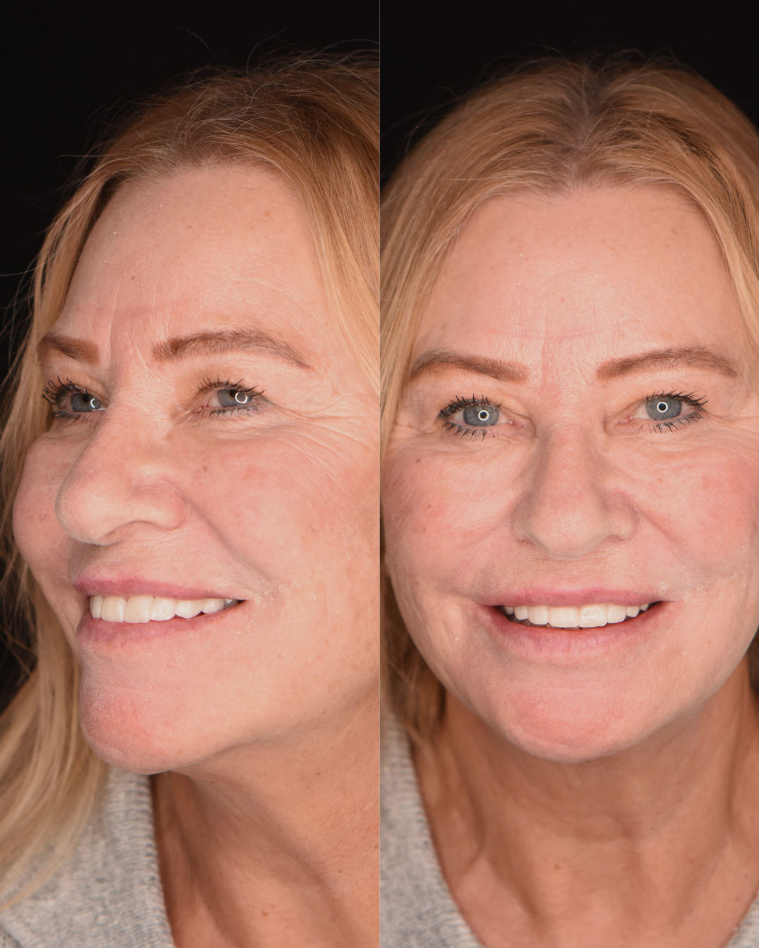 3. The Free Smile Trial