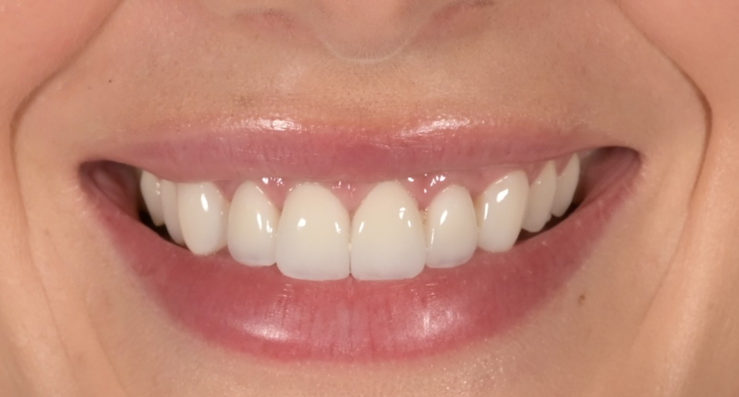 After smile