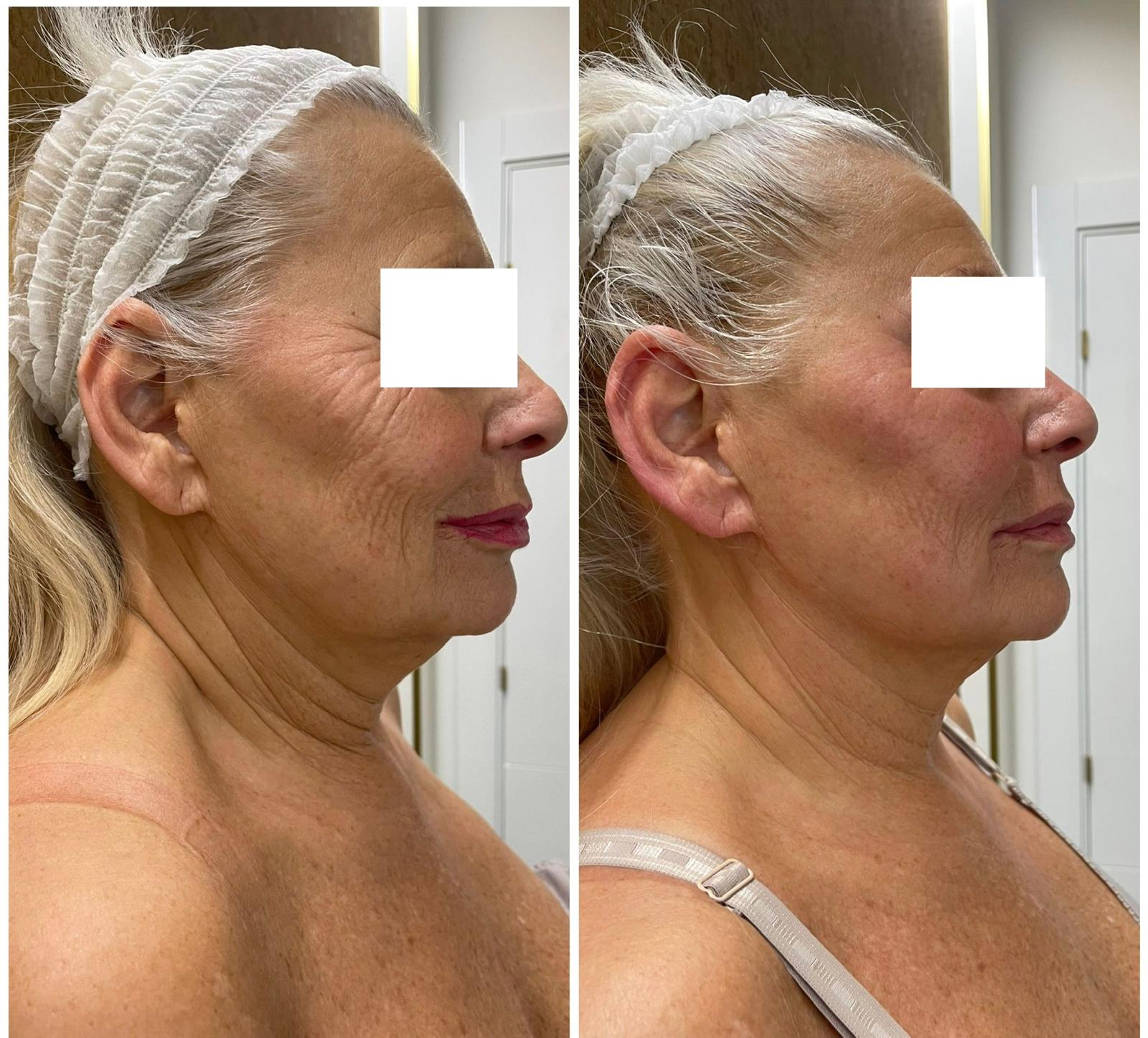Resultado antes y después del tratamiento Golden Diatermia facial en OROGOLD Center