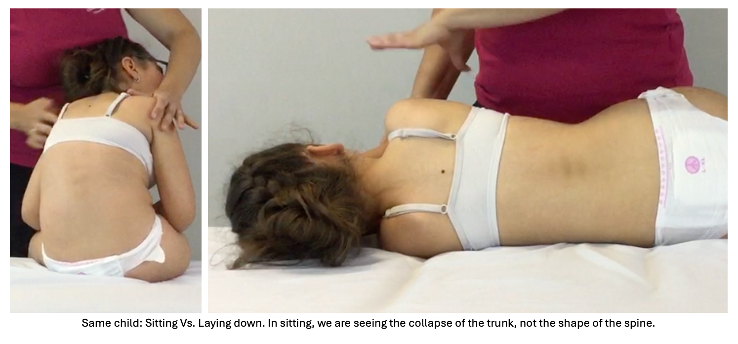 scoliosis surgery cerebral palsy scoliosis surgery cerebral palsy