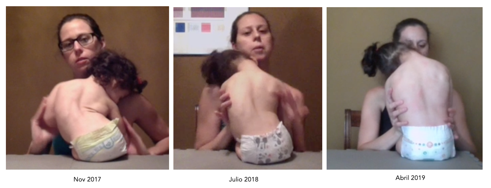 scoliosis in children with CP scoliosis in children with CP