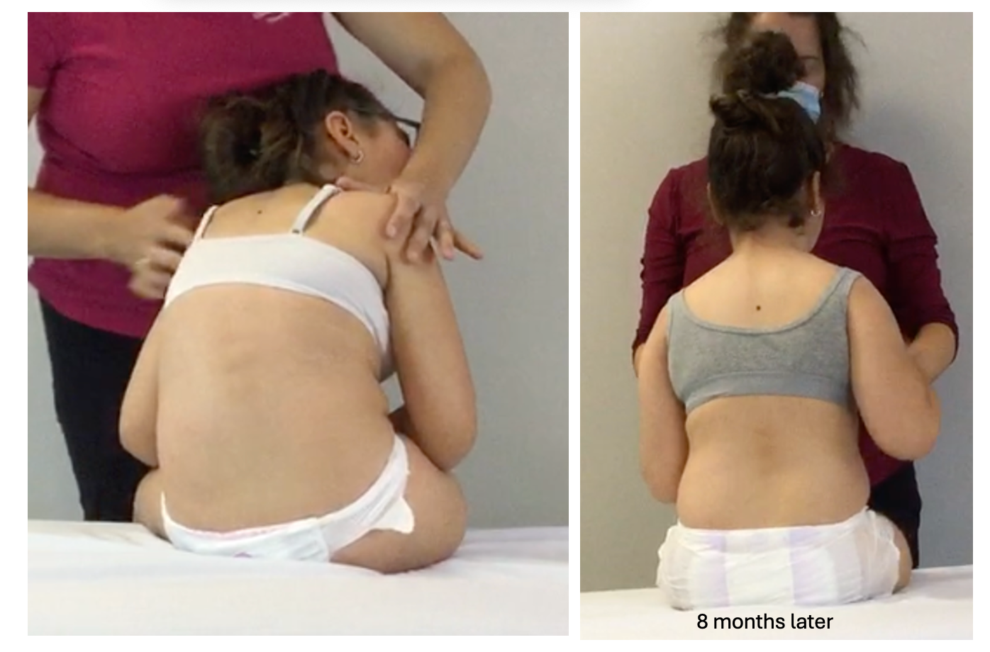 fascia therapy scoliosis fascia therapy scoliosis