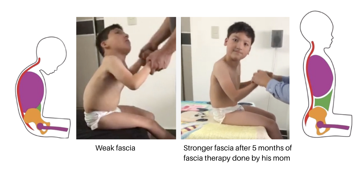 cerebral palsy posture therapy cerebral palsy posture therapy
