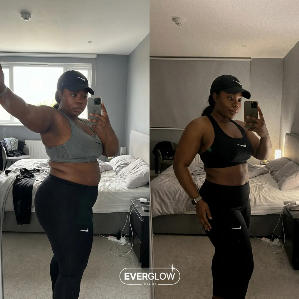 Everglow patient before and after weight loss transformation