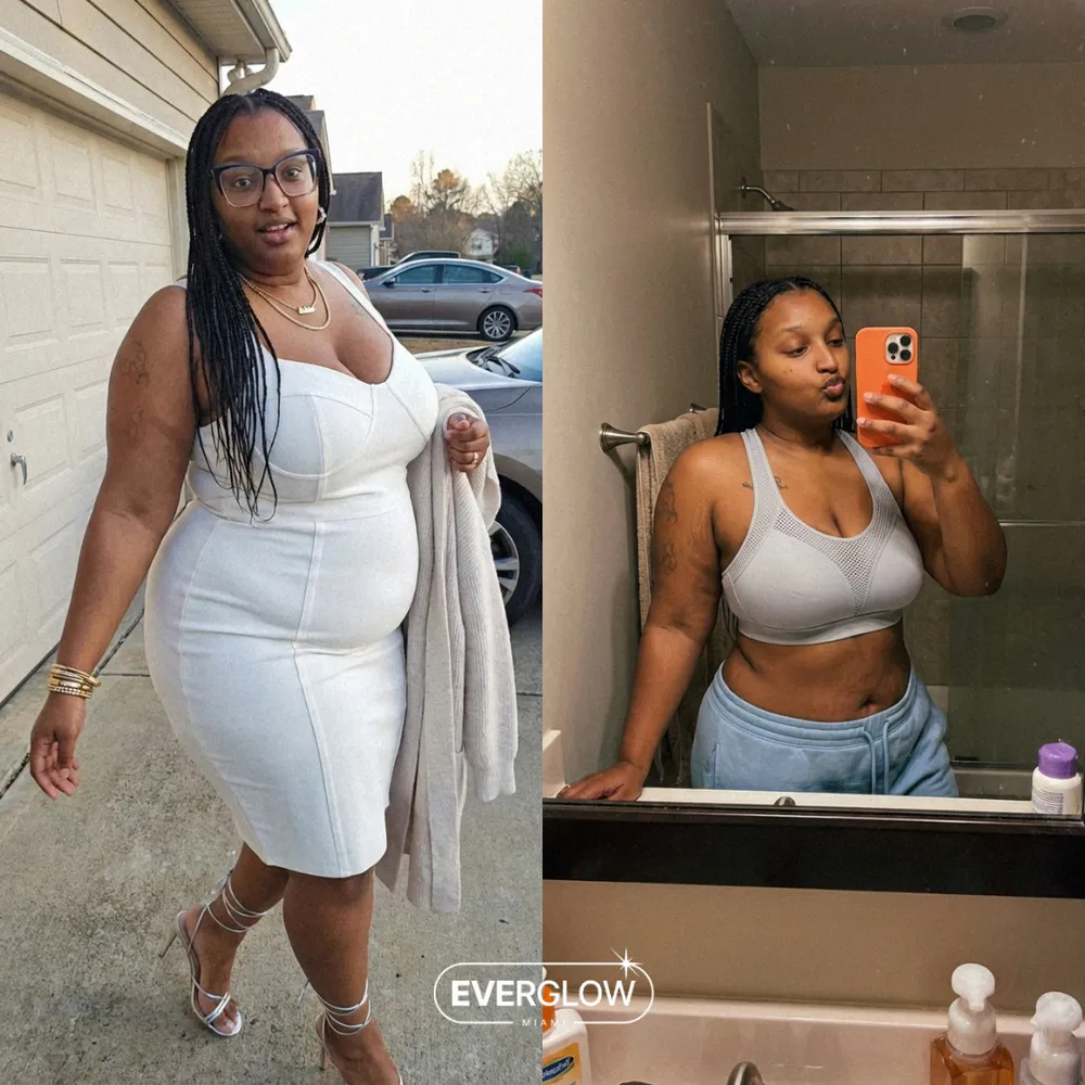 Everglow patient before and after weight loss transformation