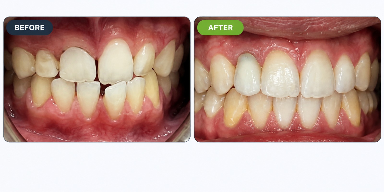 A&M Dental Arts patient alignment before and after treatment