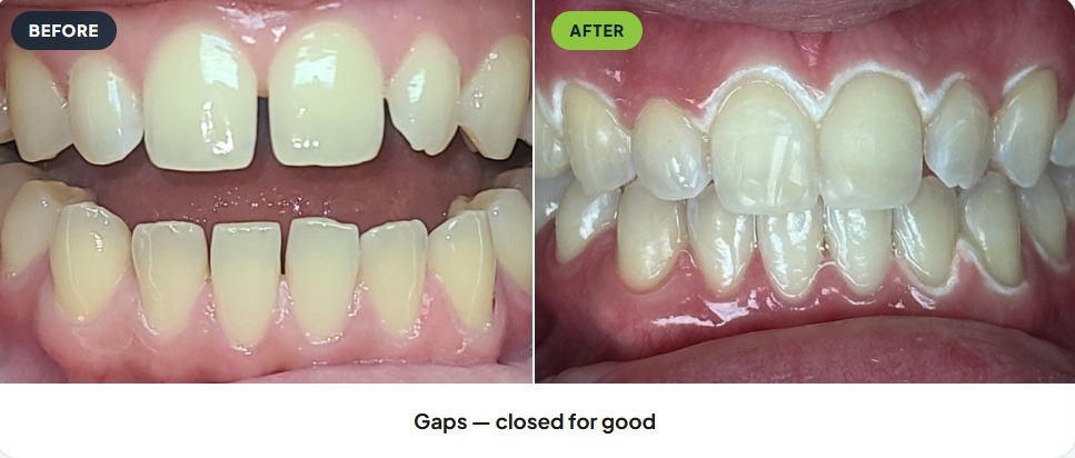 A&M Dental Arts patient smile before and after Invisalign treatment