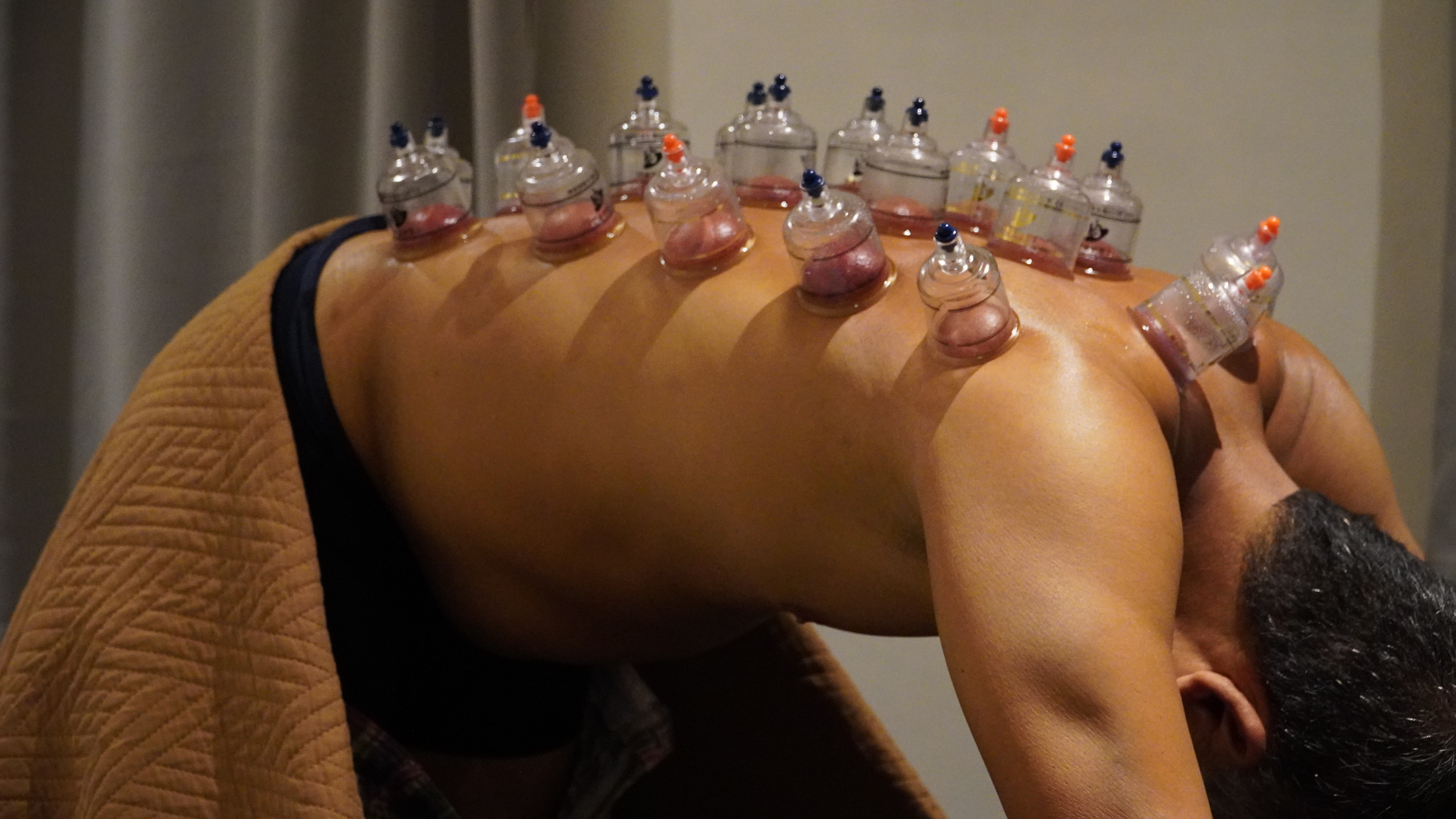 A licensed physiotherapist giving a cupping treatment