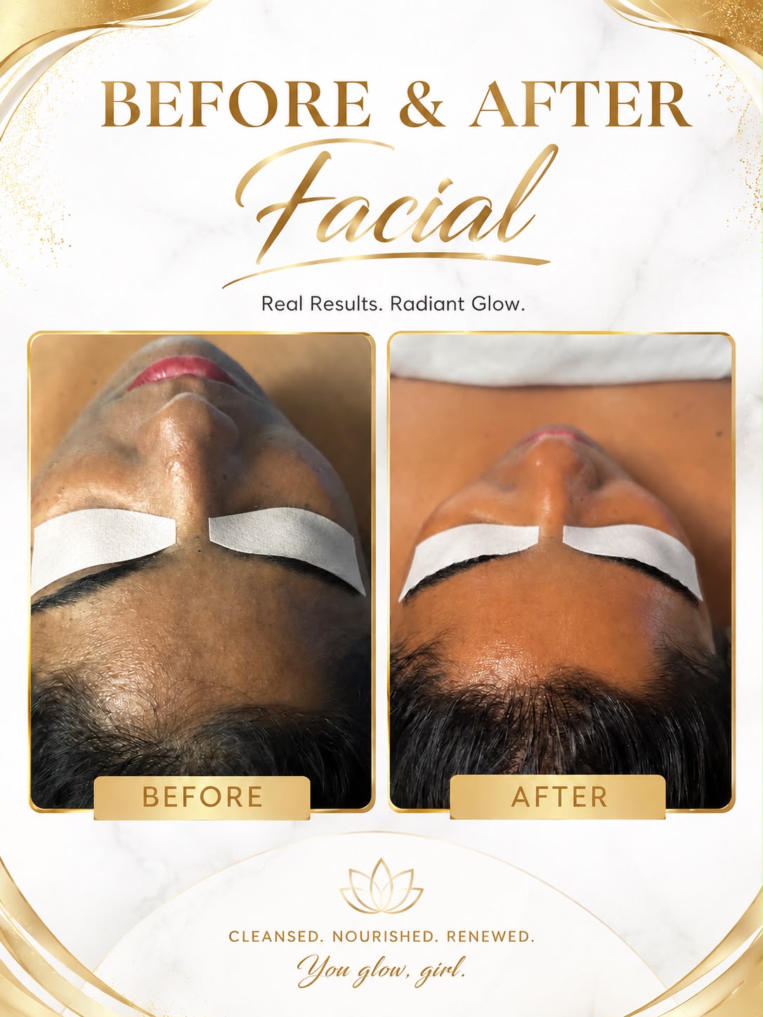 HydraFacial Clear Pores Before and After
