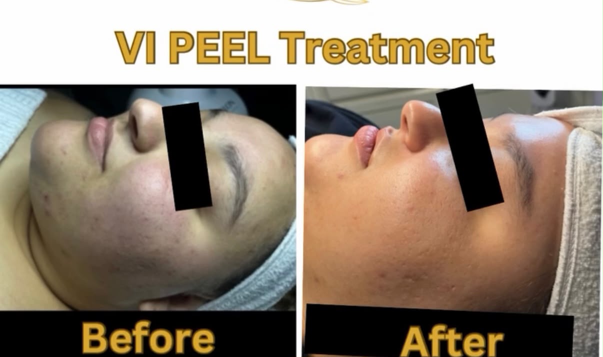 VI Peel Treatment Before and After