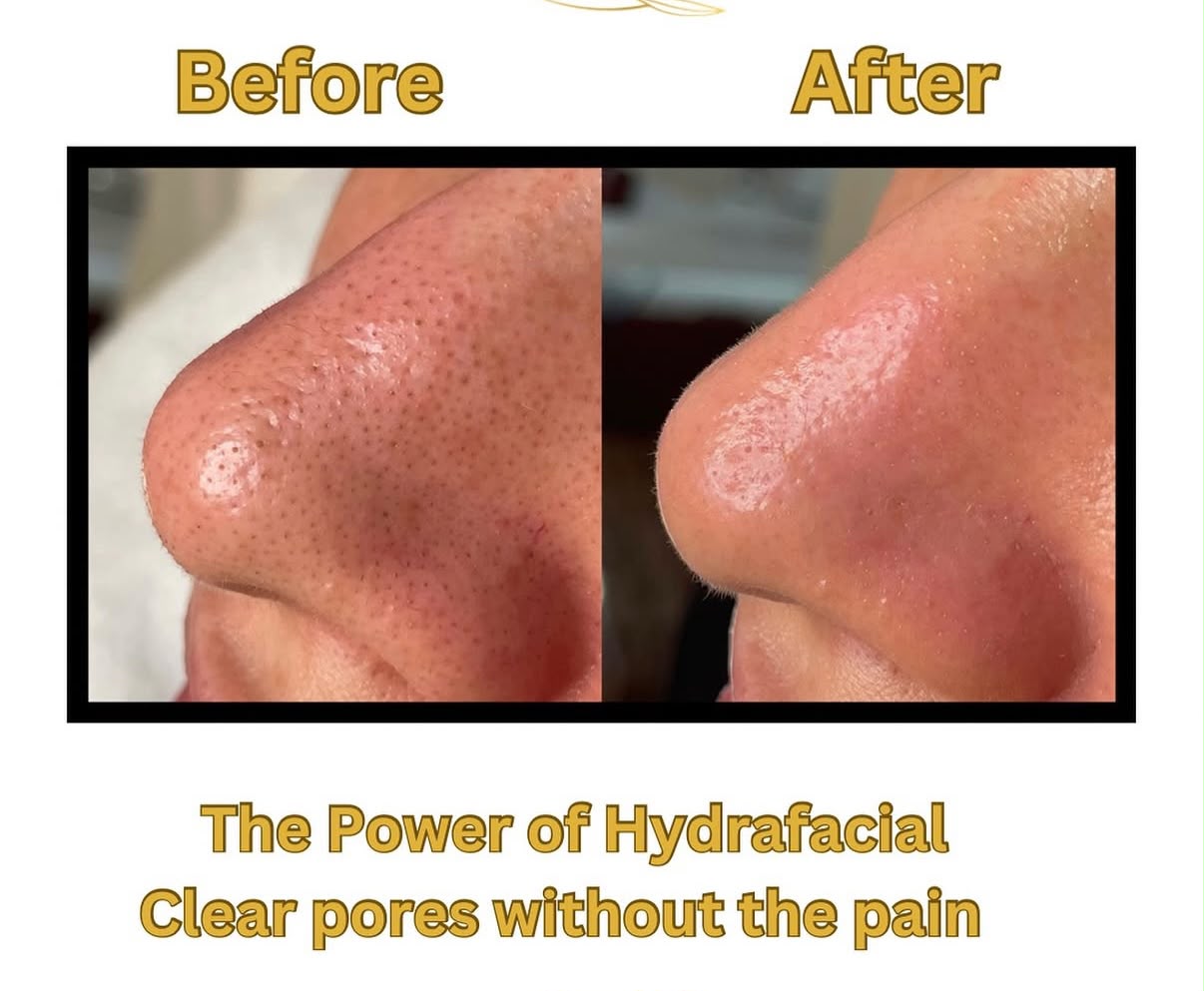 Facial Before and After