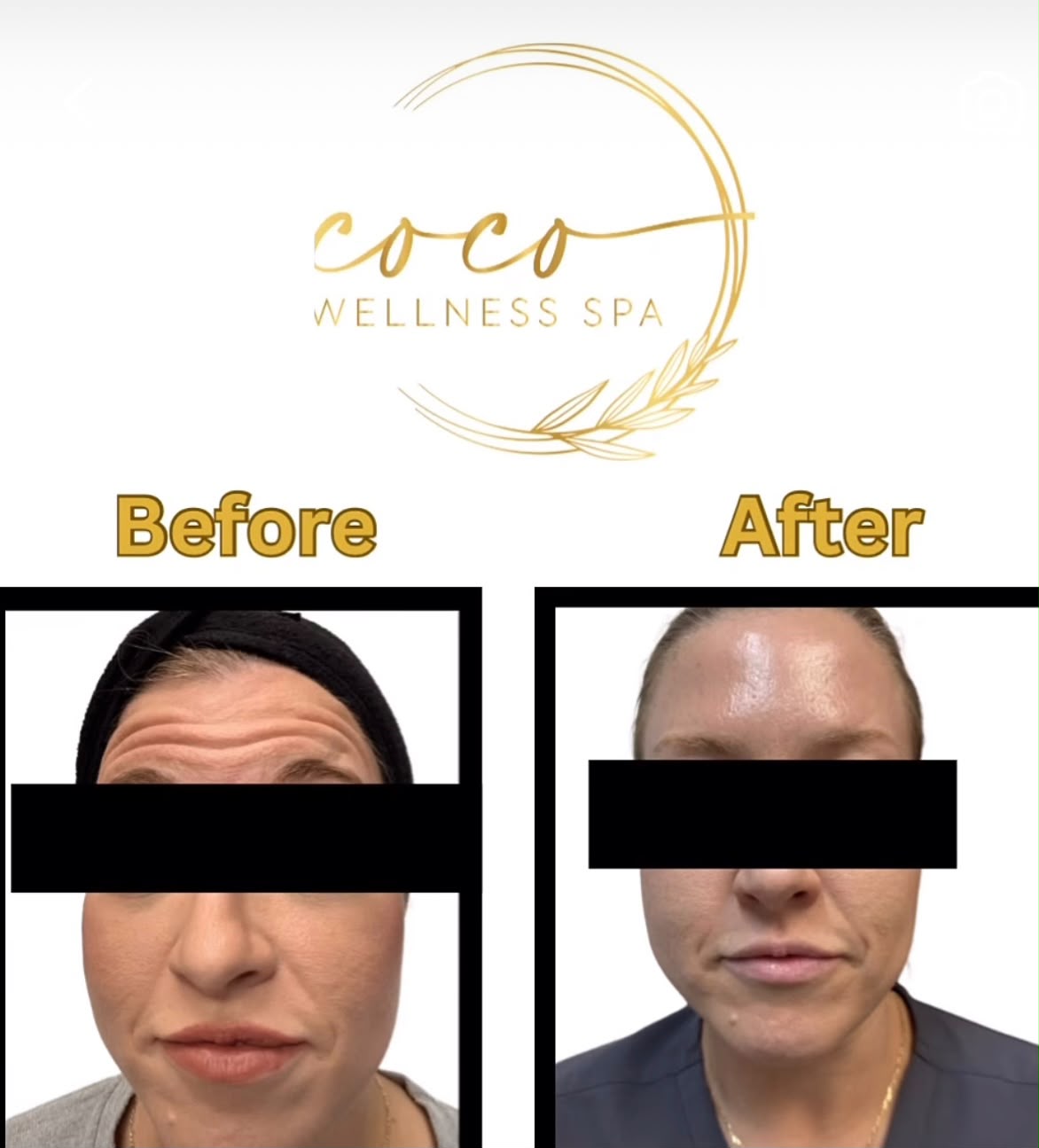Dermal Fillers