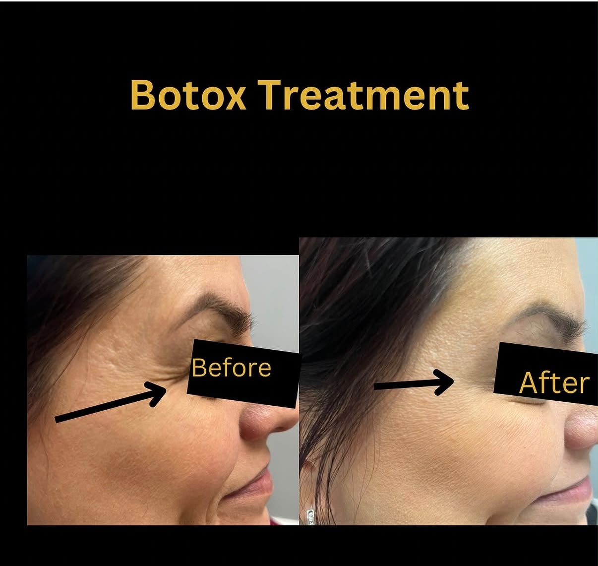 Botox and Dysport Anti-Aging Injections