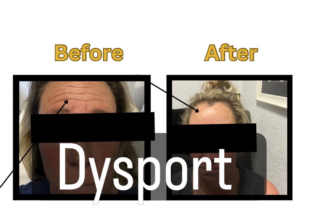 Forehead Lines & Expression Smoothening