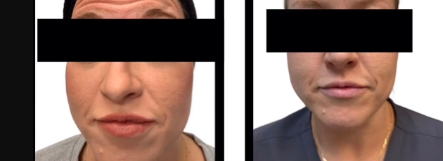 Dermal Fillers