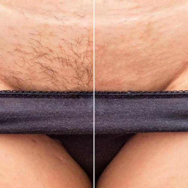 Bikini Waxing Zürich