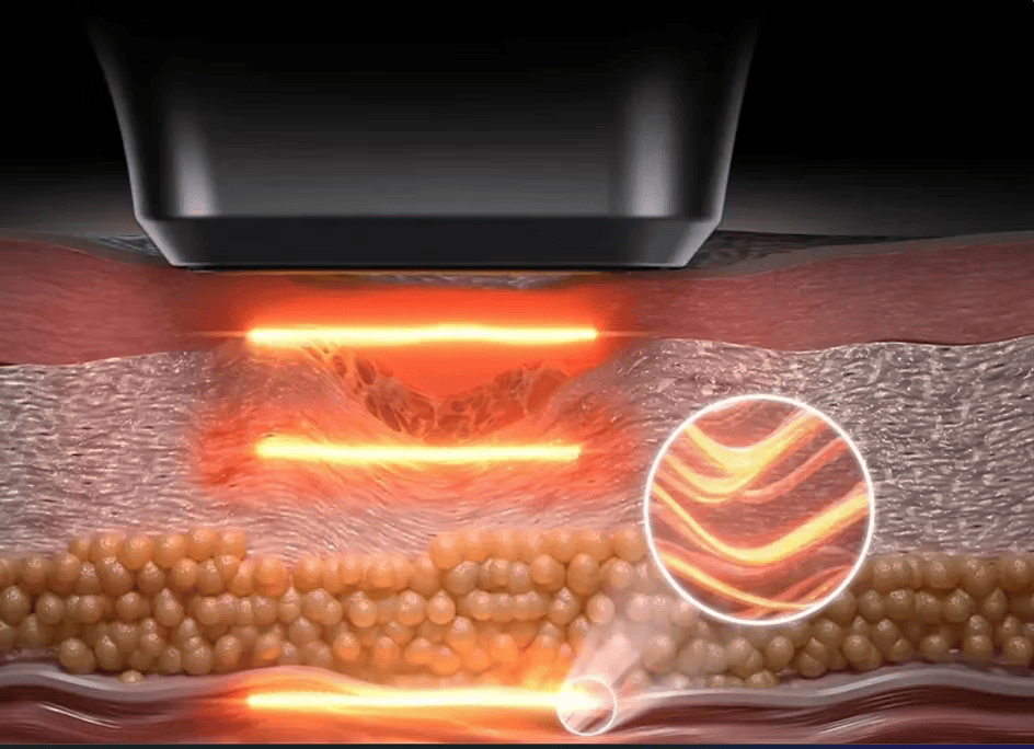 HIFU Technology Visualization