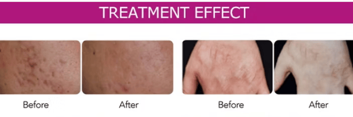 Advanced Surface Refinement