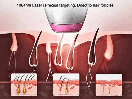 Laser Bars