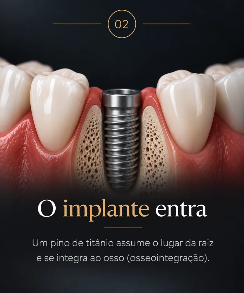 Etapa 2 — O implante entra: um pino de titânio assume o lugar da raiz e se integra ao osso.