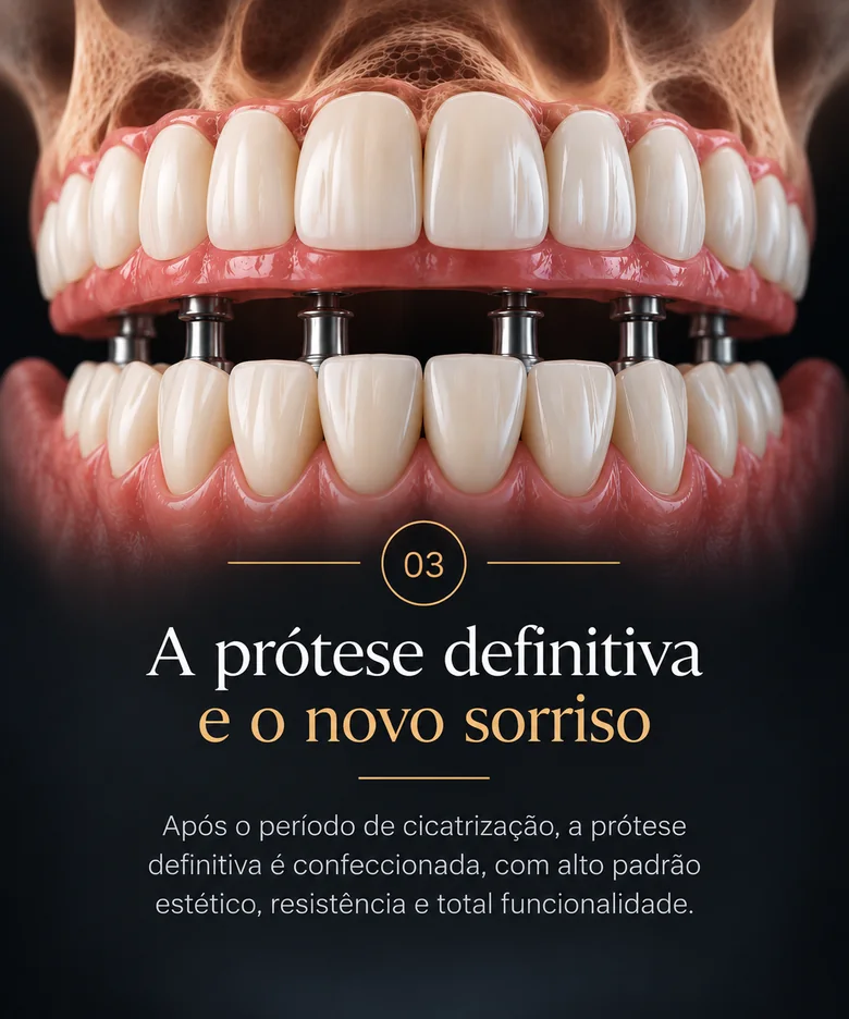 Etapa 3 — A prótese definitiva é instalada após o período de cicatrização.