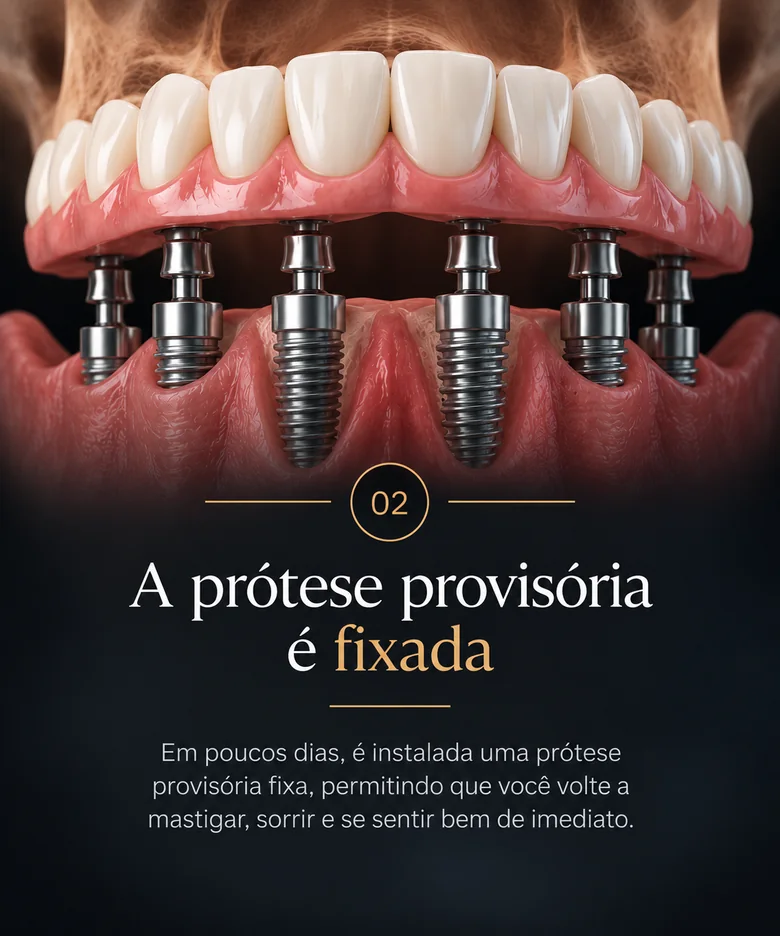 Etapa 2 — A prótese provisória é fixada sobre os implantes.