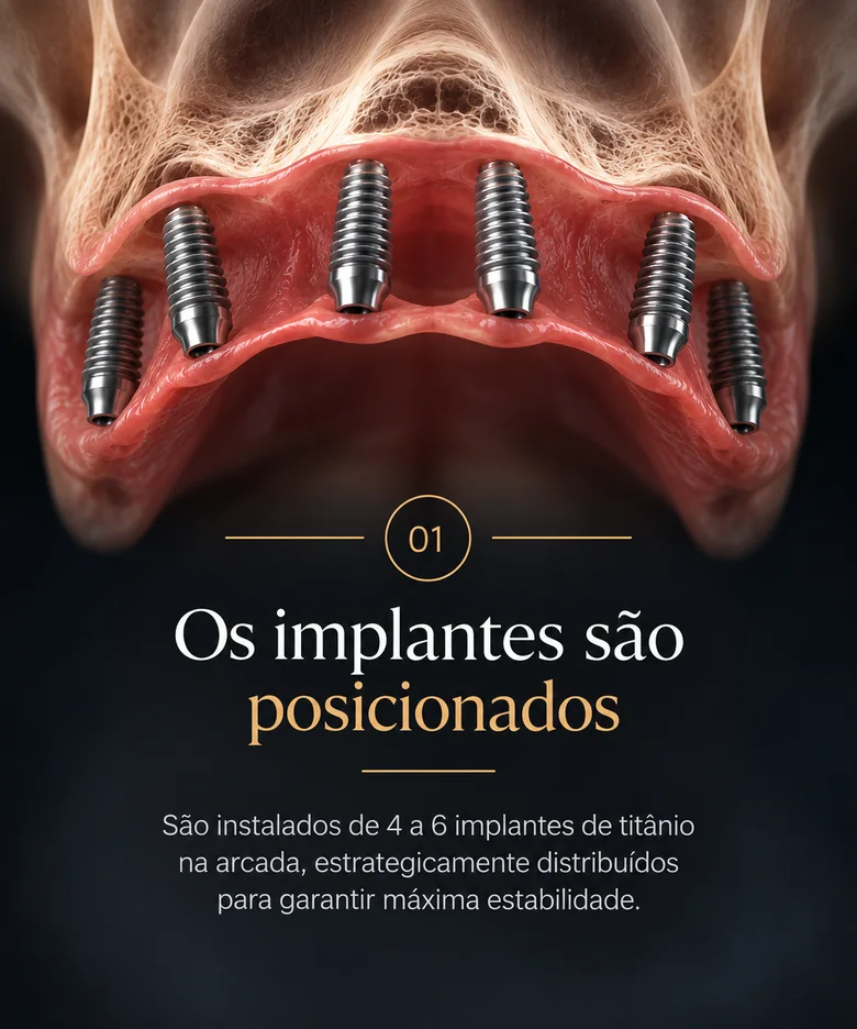 Etapa 1 — Os implantes são posicionados: de 4 a 6 implantes de titânio distribuídos na arcada.