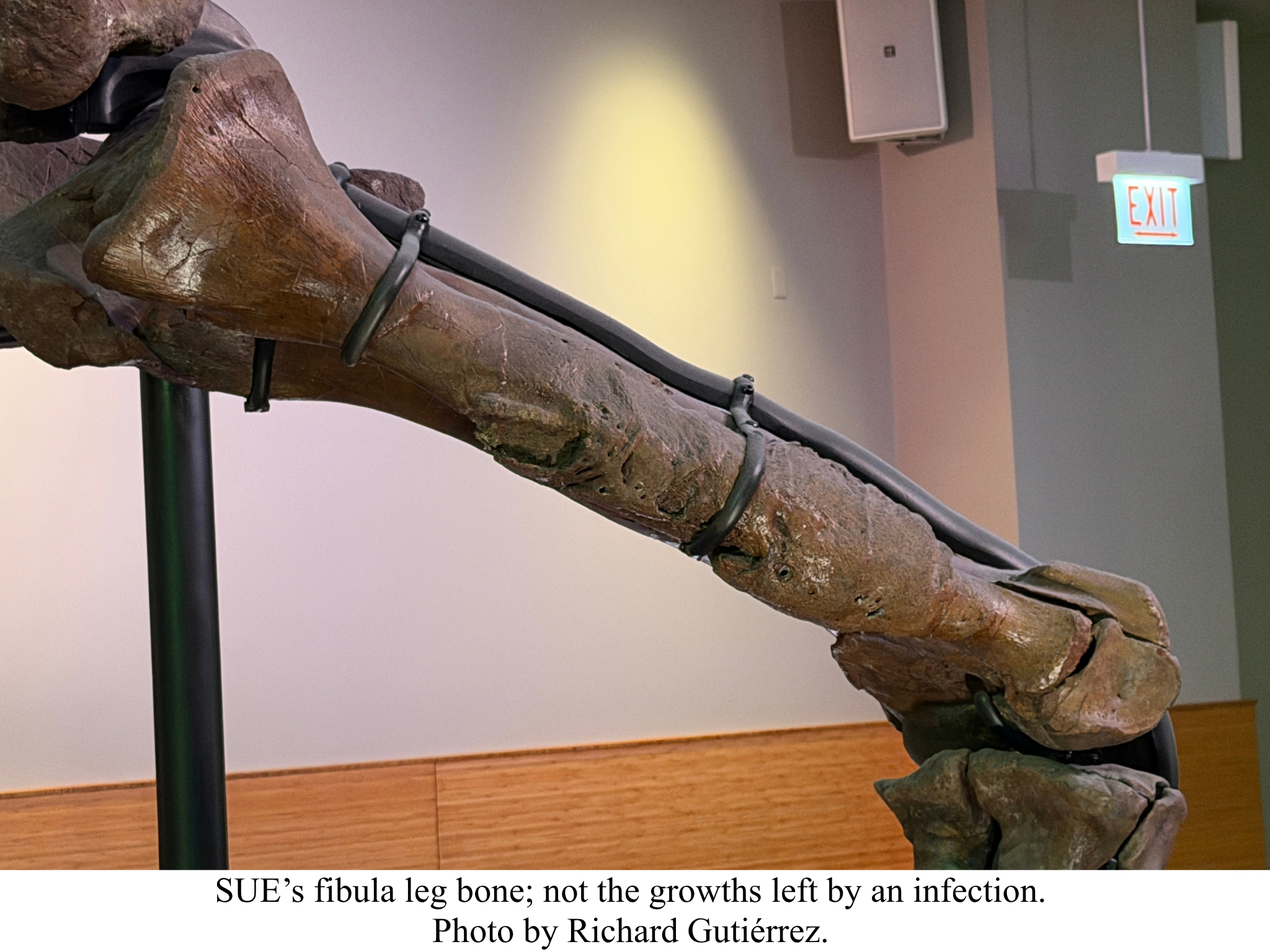 SUE leg bone with infection