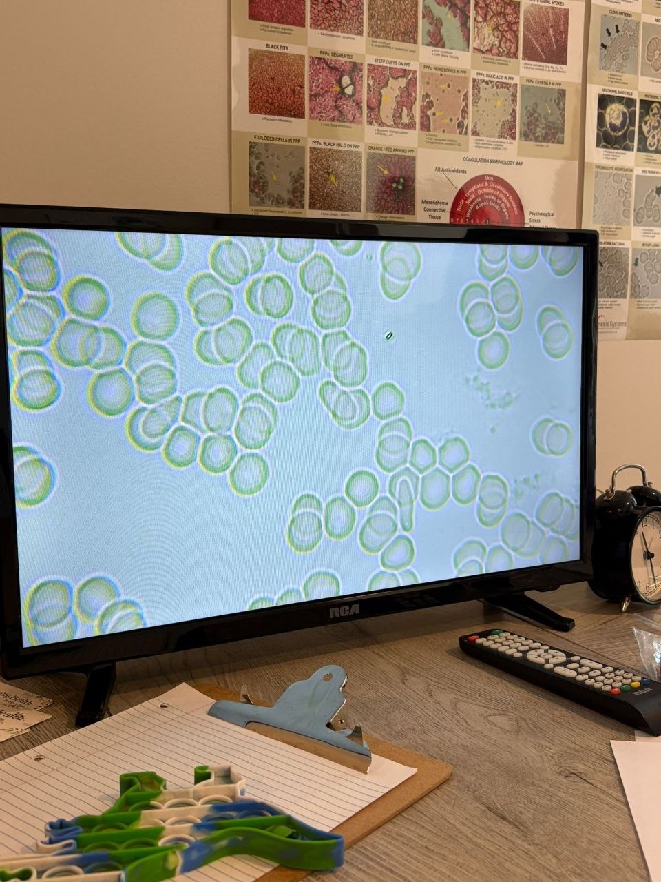 Red blood cells before ERW water showing rouleaux and clumping