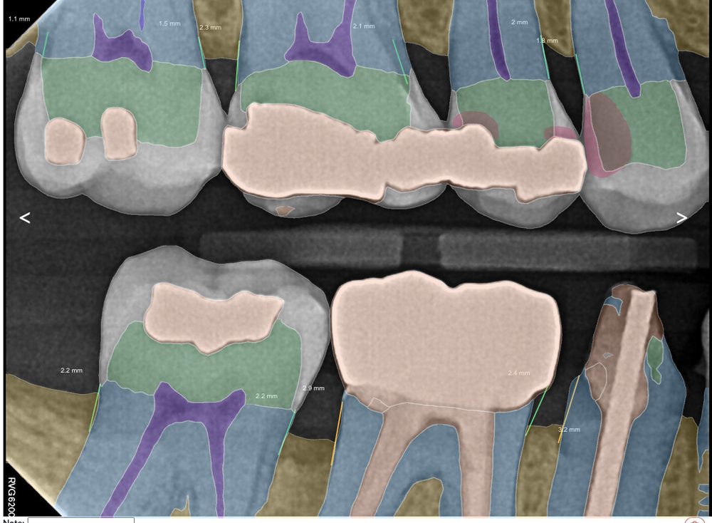 Real patient X-ray with AI anatomy overlay at Spring Hope Family Dentistry