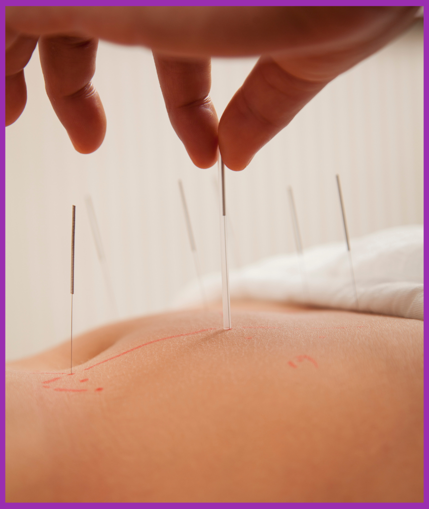 Acupuncture therapy for pain management and holistic wellness.