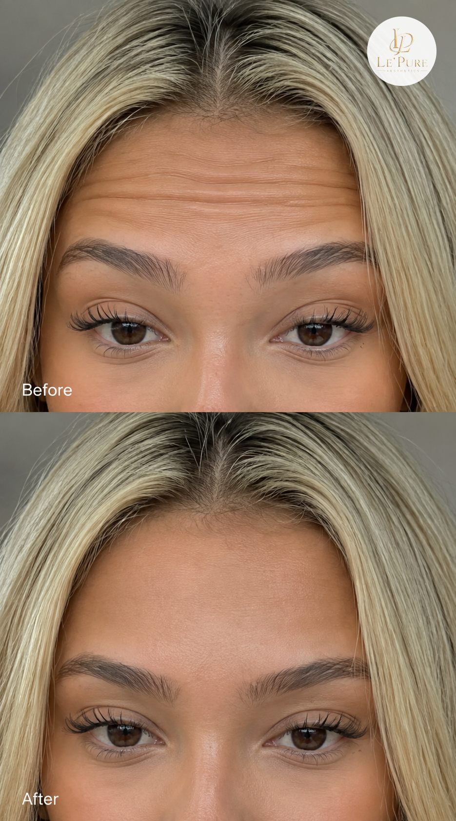 Le’Pure treatment comparison 4, before and after