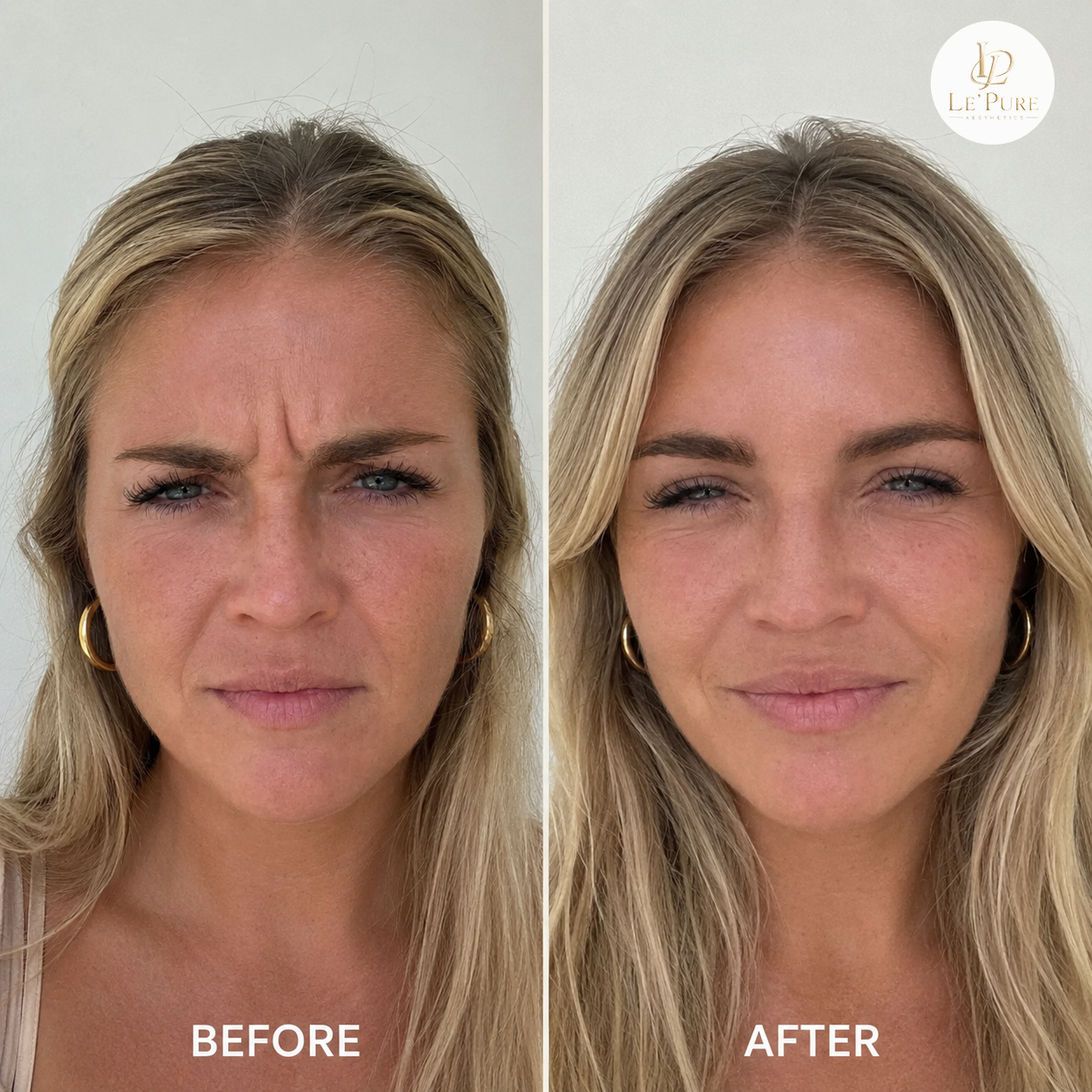 Le’Pure treatment comparison 2, before and after
