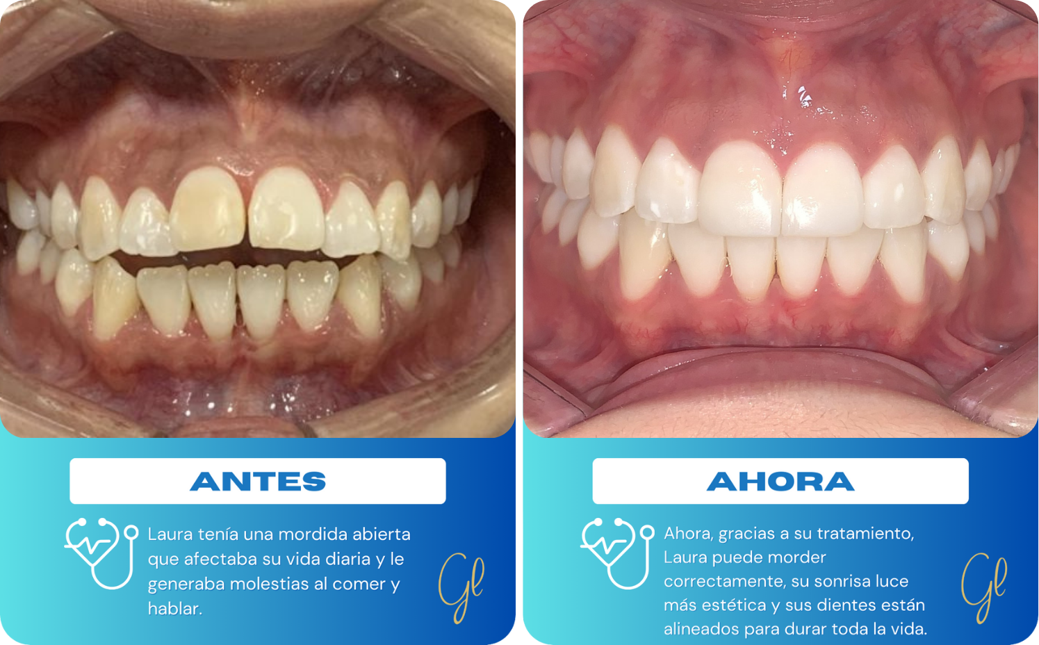 Caso de mordida abierta corregido con ortodoncia invisible invisalign en menos de un año.