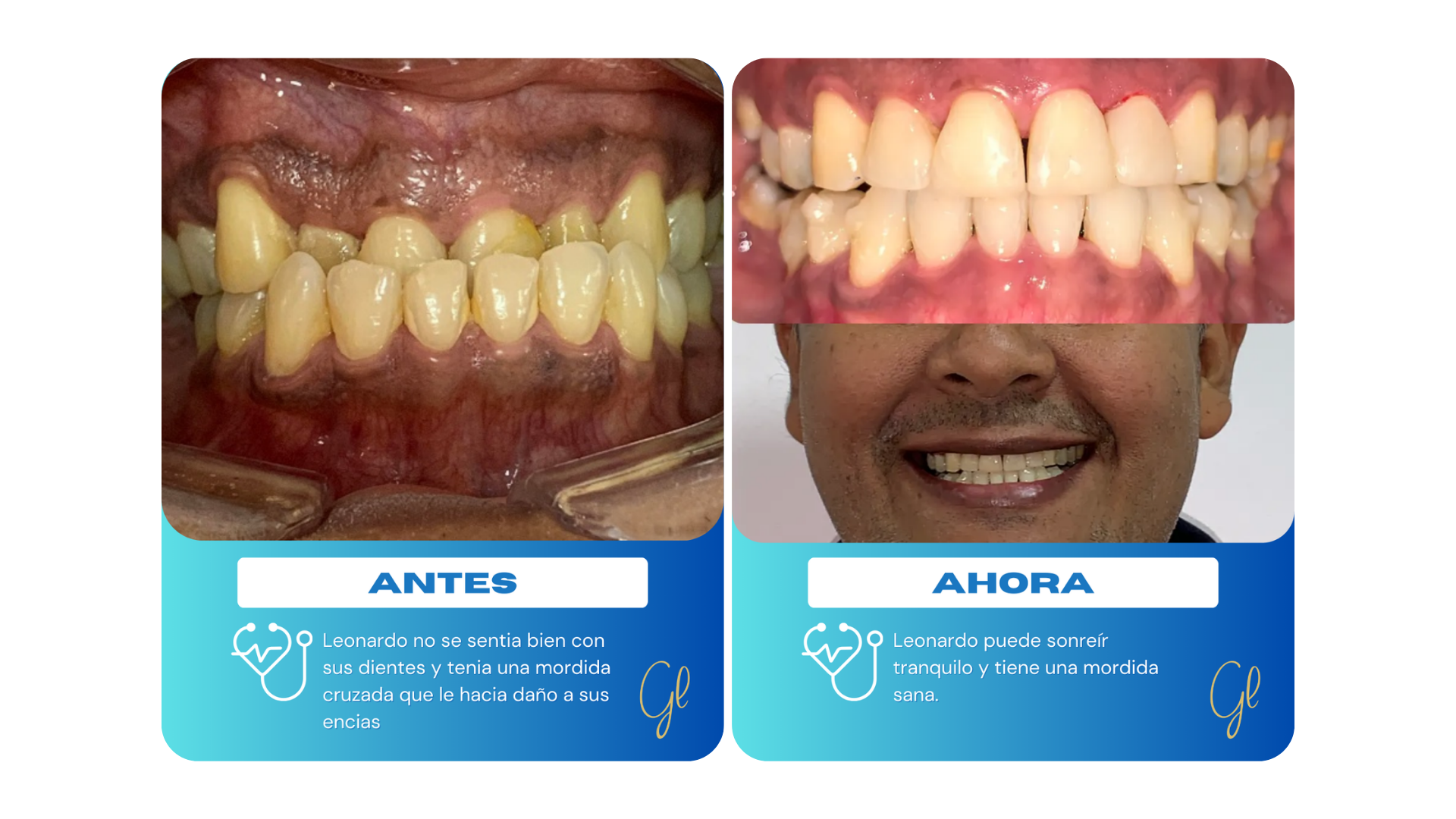 Mordida cruzada en estado deplorable recupera su estética y su funcionalidad, resaltando el antes y el después de utilizar ortodoncia invisible con invisalign