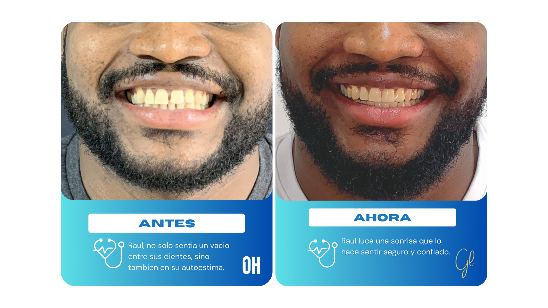 Antes y después de un paciente de la Doctora Gloria Rivera que tenía espacios entre los dientes y una mordida desalineada y muestra su cambio radical hasta quedar con los dientes hermosos y una mordida funcional