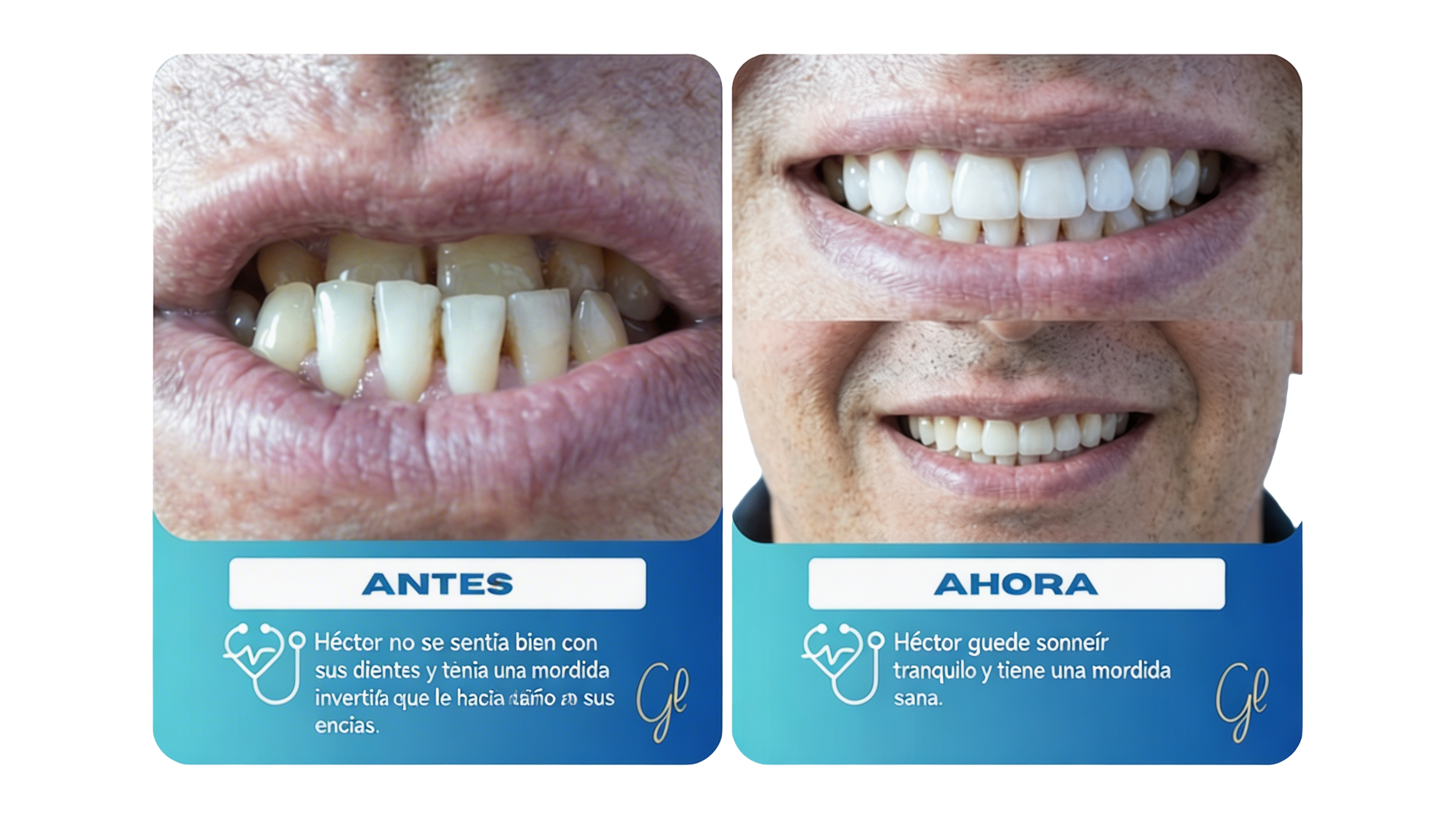 transformación de mordida invertida corregida a través de la ortodoncia invisible invisalign