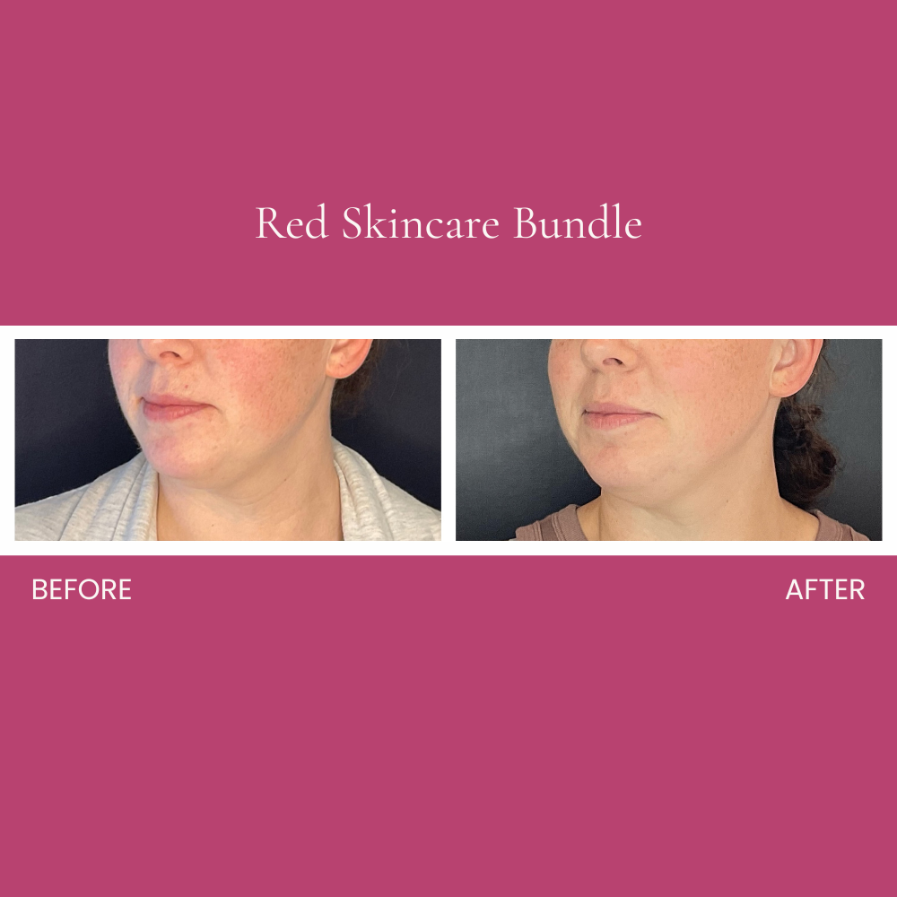Red Skincare Bundle Before and After